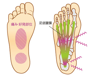 一般的な足底腱膜炎への考え方